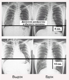 Plućna hipertenzija: simptomi i liječenje, opasnosti od bolesti - Astma February